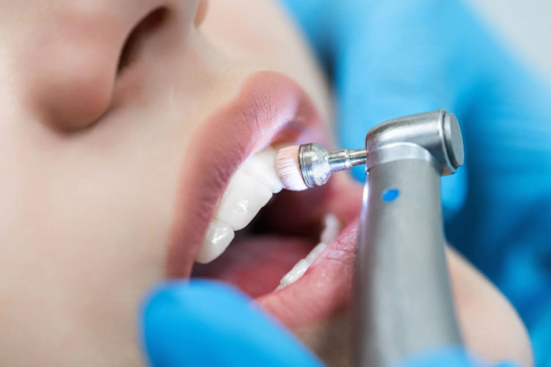 Teeth Cleaning